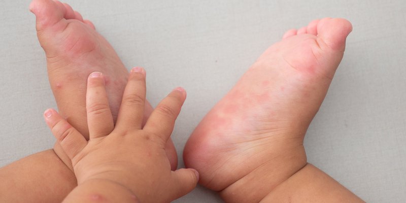 Mách các mẹ phòng bệnh chân tay miệng vào mùa Đông cho các bé